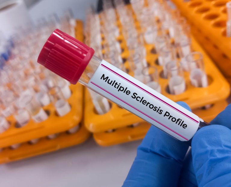 Signs of multiple sclerosis can be detected in blood 5 years before symptoms appear, new study finds. Here’s why this breakthrough is important.